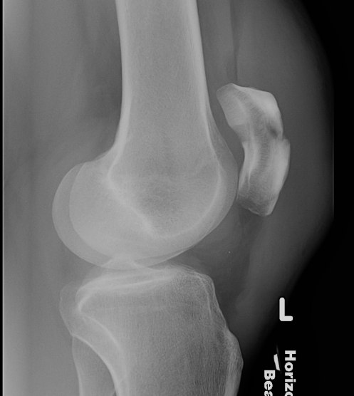 Patella Fracture Transverse